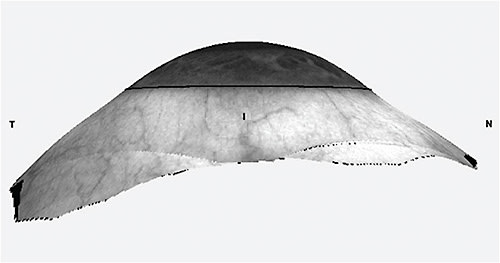 FIGURE 1. The nasal scleral quadrant has a flatter profile than the temporal.Figure courtesy of Greg DeNaeyer, OD