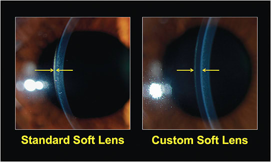 Figure 2. An example of the greater center thickness of a custom soft lens (on the right) versus a standard soft lens (on the left).