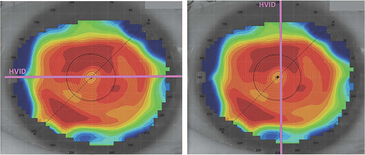 Figure 2. Corneal maps showing the rotation of the segment measuring the HVID. Vertically, it appears significantly larger than the VVID.