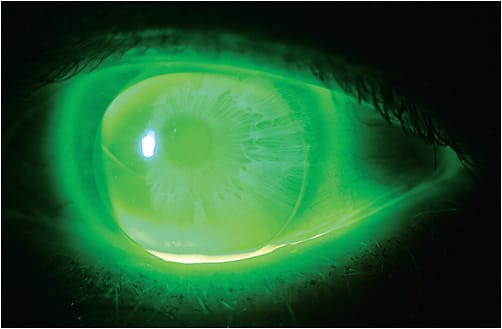 FIGURE 1. Good fit with alternating GP bifocal lens. Photo courtesy of Susan Gromacki, OD, MS.