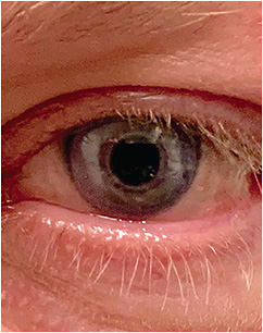 Figure 2. Prosthetic soft lens.