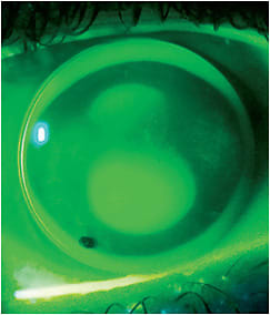 Figure 1. A lens that needs toric peripheral curves.
Image courtesy of Dan Fuller, OD