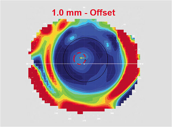 Figure 2. OS, 0.32mm misalignment, direction: nasal.