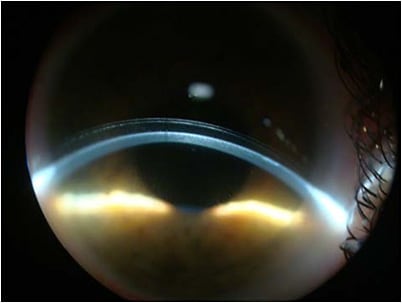 Figure 10. Scleral lens vault after nine hours wear.