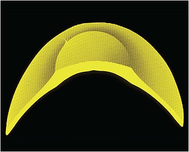 Figure 1. A keratoconus-design custom soft lens. The central portion is steep and also represents the thickest area of the lens, whereas the outer section is much flatter in curvature.