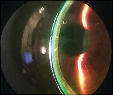 Figure 5. A scleral lens on an eye that has undergone radial keratotomy.