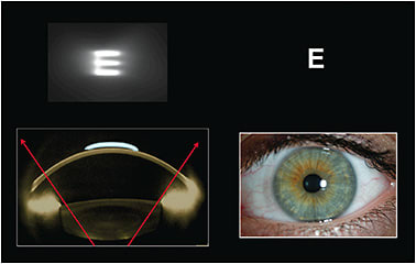 Figure 4. Glare and halos from a too-small optic zone.