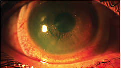 Figure 1. Hyperemia and irritation with a scleral lens OD.