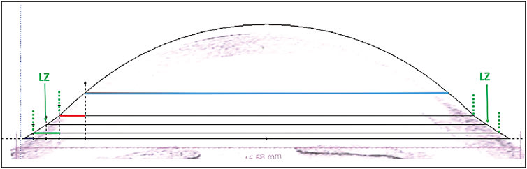 Figure 2. Scleral lens design on cross-sectional tomogram produced by optical coherence tomography showing that the only zone that bears on the ocular surface (the sclera) is the extension of the LZ.