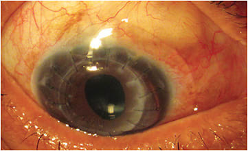 Figure 3. A scleral lens successfully vaulting a conjunctival bleb.