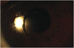 Figure 1. Poor surface quality of a scleral lens due to residue from the application plunger.