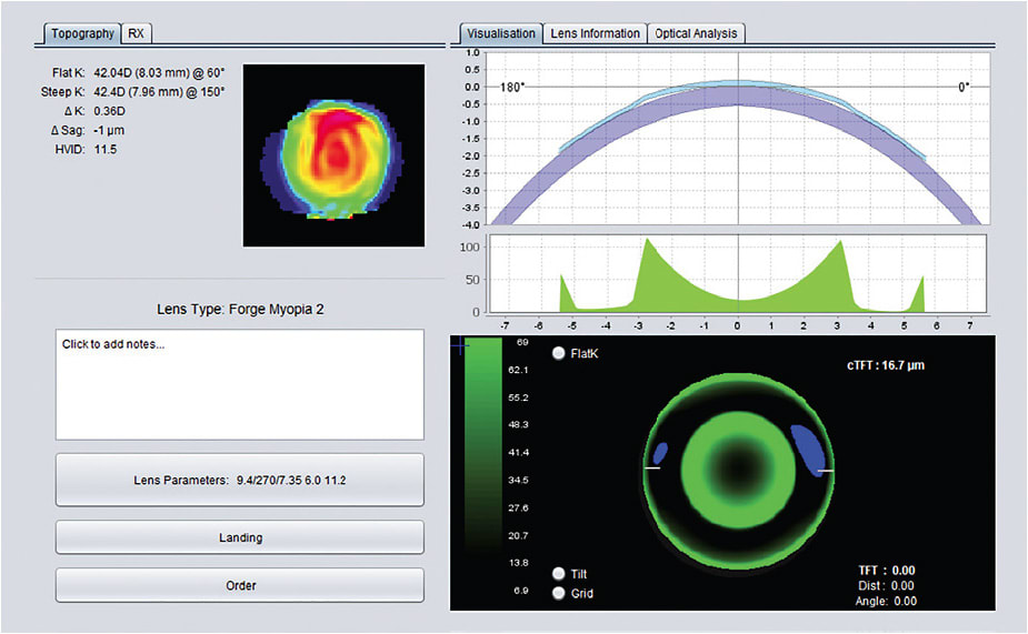 Figure 1. Design software showing the simulated fluorescein pattern and calculated tear layer profile of an orthokeratology lens design.