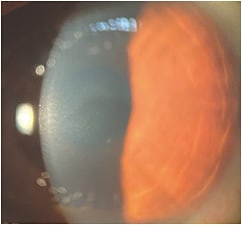 Figure 2. One month post-topical therapy, with visual acuity returning to 20/20 OD and OS.