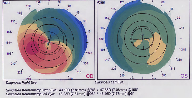 Figure 2. Topography maps of the patient’s right and left eyes.