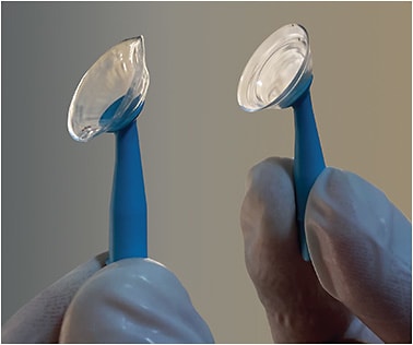 Figure 1. Both of these scleral lenses have the same base curve of 6.37mm, power of –13.62D, and diameter of 16.5mm; it is clear that if this patient takes the prescription to a GP lens lab to manufacture a custom GP lens with these limited parameters (lens on the right), the lens will not match what the practitioner prescribed (lens on the left).