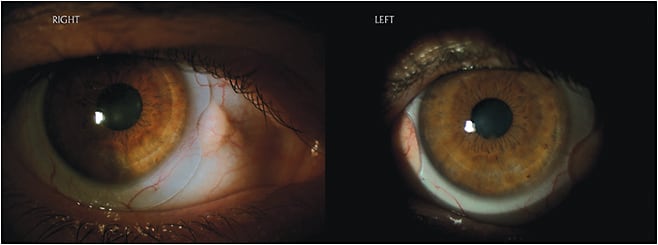 Figure 6. Notched scleral lenses that bypass pingueculas.