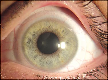 Figure 4. A front-surface-toric scleral lens stabilized with a customized back-toric haptic.