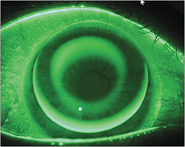 Figure 2. Superiorly decentered lens showing excessive inferior edge lift and a variable pattern.