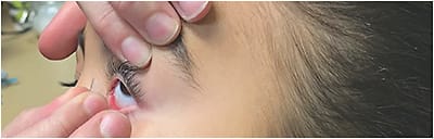 Figure 2. The high refractive error can be corrected with soft contact lenses.