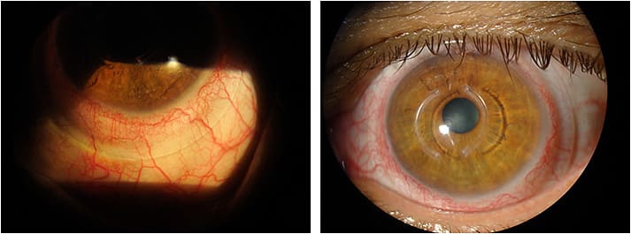 Figure 2. Impingement and blanching with the scleral lens at presentation.