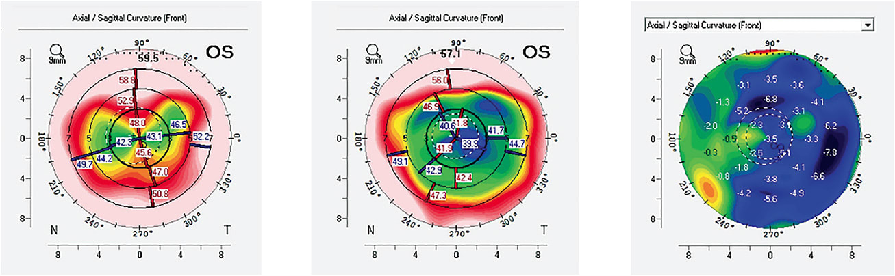 Figure 2. Difference map of irregular astigmatism two years postoperative femtosecond-assisted PK treated with topography-guided photorefractive keratectomy (TGPRK): Pre-operative axial curvature map showing 4.2D of corneal astigmatism (left), best-corrected spectacle visual acuity of 20/40 with &#8211;5.75 &#8211;5.25 x 008. Three months postoperative TGPRK axial curvature map showing 0.70D of corneal astigmatism (center), best-corrected spectacle visual acuity equal to 20/25 with &#8211;3.00 &#8211;0.50 x 115. Difference map showing curvature change as a result of TGPRK (right).