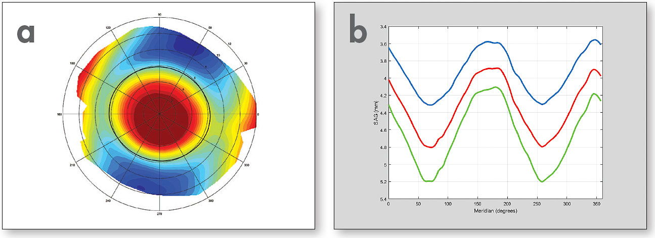 Figure 1. Corneo-scleral topography showing with-the-rule scleral topography (a). Symmetric sagittal height plots of same patient at chord diameters of 14.7mm, 15.7mm, and 16.5mm (b).