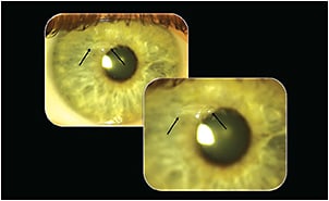 Figure 1. Salzmann&#x2019;s nodular degeneration of the right eye.