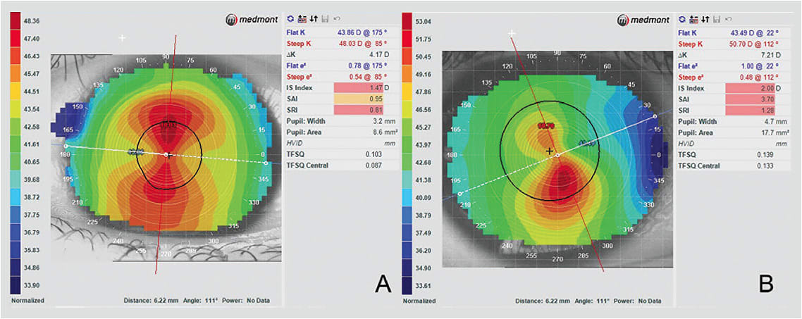 Figure 2. Regular versus irregular corneal astigmatism. Regular corneal astigmatism (A). Irregular corneal astigmatism (B).