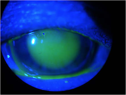 Figure 5. Fluorescein pattern of the first contact lens tried in the refit, 2017.
