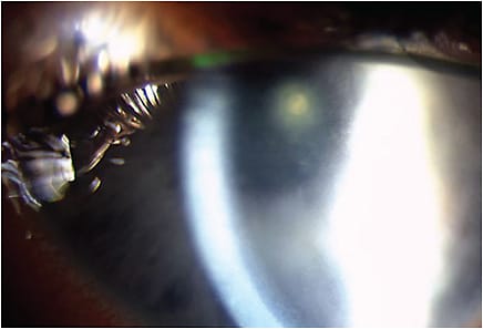 Figure 3. Bacterial keratitis secondary to Serratia marcescens. Note the stained paracentral ulcer, significant corneal edema, fine keratic precipitates, and diffuse injection.