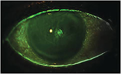 Figure 2. After two weeks of lid taping, topical preservative-free antibiotics, and preservative-free artificial tear use, the defect size has improved, but corneal epitheliopathy remained.