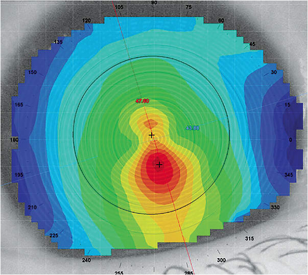 Figure 3. Irregular cornea that is best fit with a vaulted type of hybrid lens.