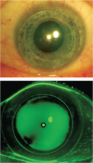 Figure 10. Diagnostic fitting of a piggyback contact lens system for a six-month postoperative femtosecond laser-assisted PK. Note the 10.5mm corneal GP contact lens resting on a high-Dk daily disposable soft contact lens. It is clear to see that the GP lens is resting on the graft-host junction. The GP lens needs to be modified in the following manner: an increase in overall diameter and optic zone diameter both by approximately 1mm, an increase in reverse geometry, and an increase in edge lift. The GP contact lens will be ordered in a hyper-Dk material.