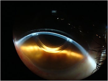 Figure 7. The lens vault with the new scleral lens.