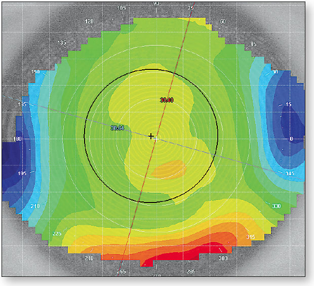 Figure 2. Daily disposable hydrogel. Residual Astigmatism: 0.76D