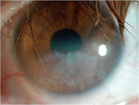 Figure 2. An example of corneal neovascularization in a patient who has Stevens-Johnson Syndrome, demonstrating pannus and opacification. This cornea may benefit from anti-VEGF treatment.
Photo courtesy of Lynette Johns, OD.