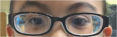 Figure 1. Marfan syndrome can cause high myopia, astigmatism, and anisometropia.
