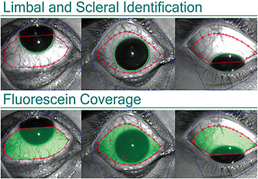 Figure 8. Scleral topography allows for imaging of both the corneal and scleral contour. This information is valuable for initial scleral contact lens selection and troubleshooting lens design.