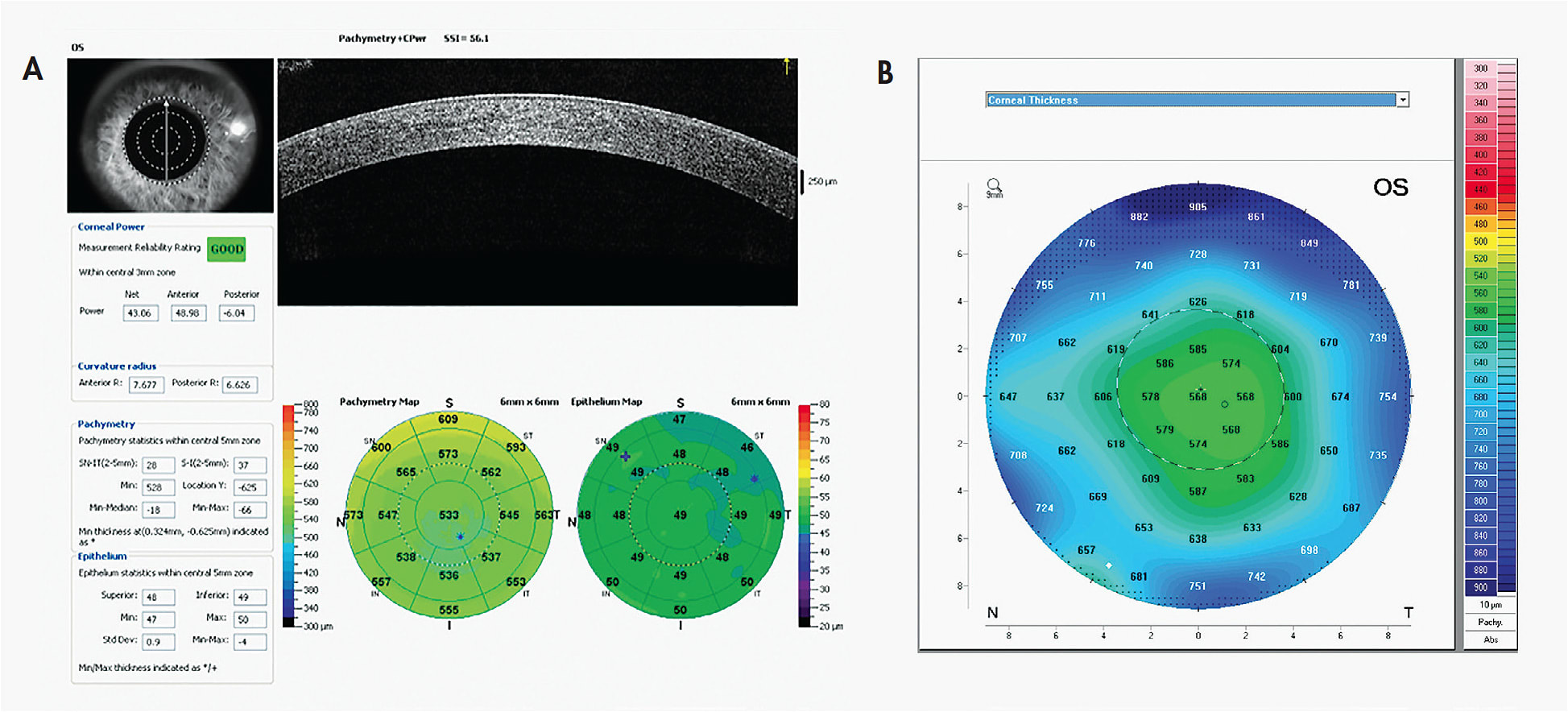 Figure 4. Optical pachymetry. (A) OCT-based optical pachymetry, showing overall corneal thickness (left map) and epithelial thickness (right map). (B) Scheimpflug camera-based optical pachymetry.