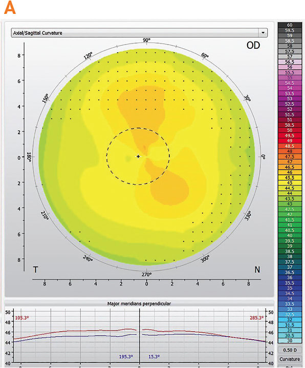 Figure 1. (A) Axial map-derived keratometry was used to choose initial lenses.