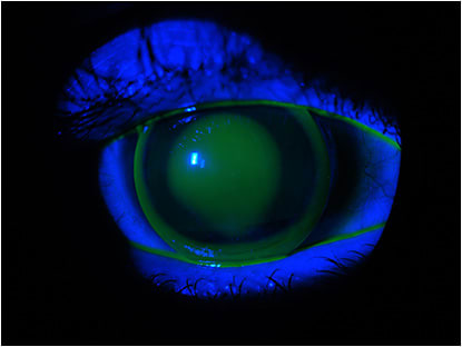 Figure 4. First trial lens.