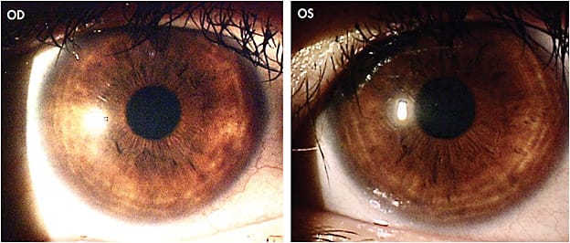 Figure 3. Healthy corneas in the patient from Case 1 after one year of scleral lens wear.
