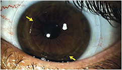 Figure 1. A hybrid lens on an eye with low corneal cyl during initial dispense study visit. Note bubbles at the junction between the GP center and soft skirt. These bubbles are commonly observed during the first application.