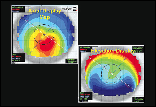 Figure 1. Axial and elevation display maps of a patient who has early keratoconus.