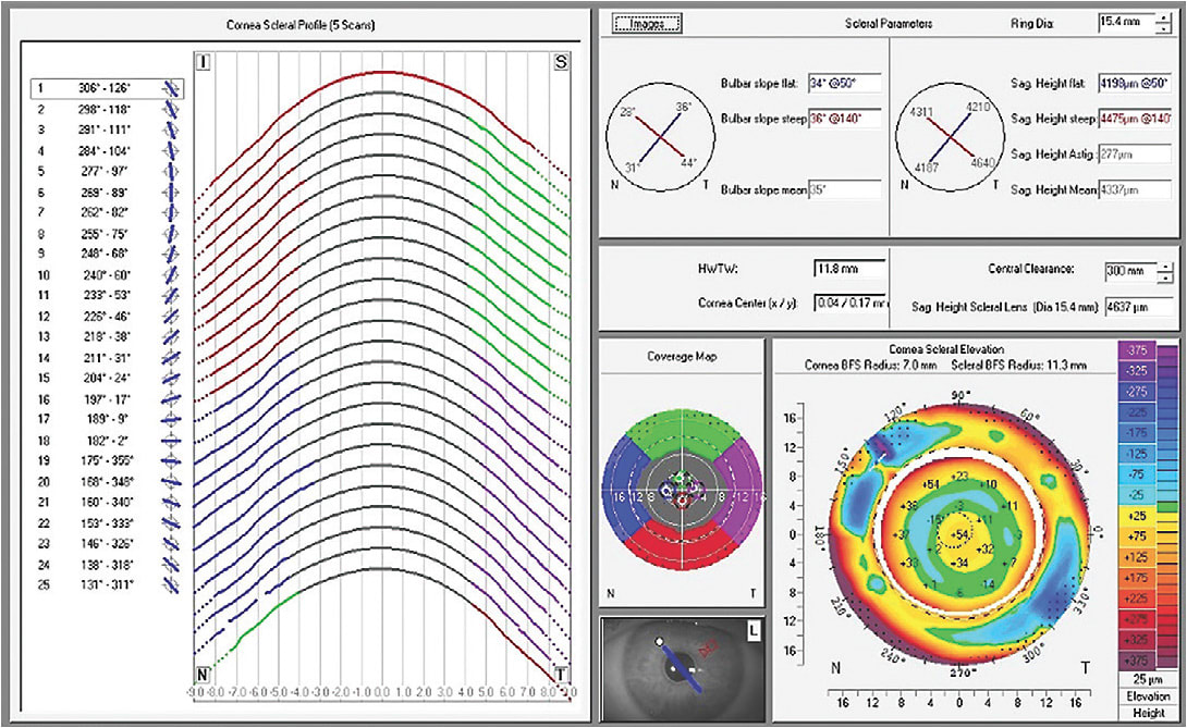 Figure 3. Software report from a corneal tomographer. The left half shows the sagittal height of each individual cross section. The bottom right is an elevation map of the cornea and sclera. The upper right contains sagittal height data that is adjustable.