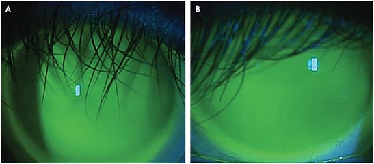 Figure 4. The scleral lens fitting relationship for the right (A) and left (B) eyes of the patient in Case 6.