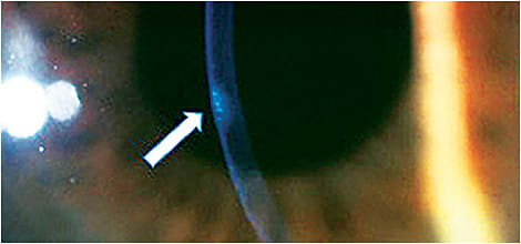 Figure 1. Corneal infiltrative event in the central cornea (arrow) of a contact lens wearer. The infiltrates are penetrating to about one-third of the corneal depth.