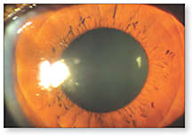 Figure 2. The same eye with a lens with the Hydra-PEG coating.View video here