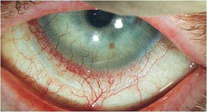 Figure 1. Scleral edge impingement resulting in long-term neovascularization of the cornea.