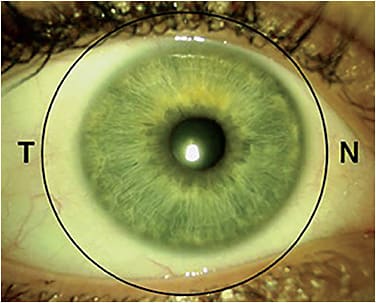 Figure 2. This image shows the temporal decentration of a soft contact lens. Significant decentering can affect optical performance and lens comfort. Image courtesy of Matt Lampa, OD